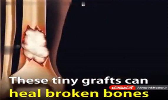 روشی جدید برای درمان شکستگی استخوان