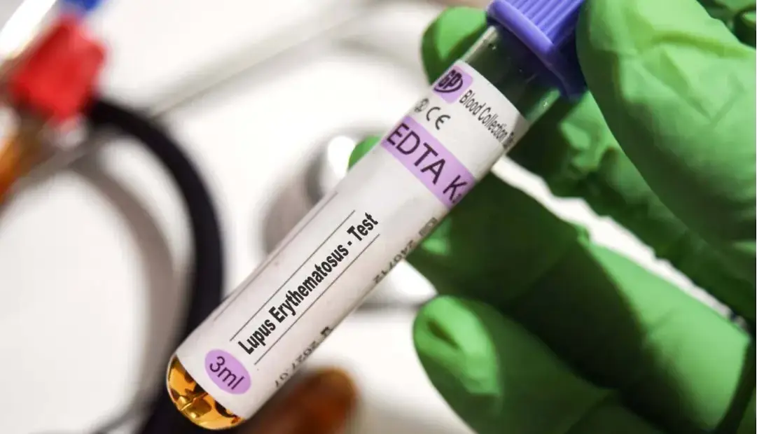 کشف قوی‌ترین شواهد از نقش ویروس اپشتین بار در بروز بیماری لوپوس